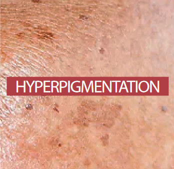 Hyper