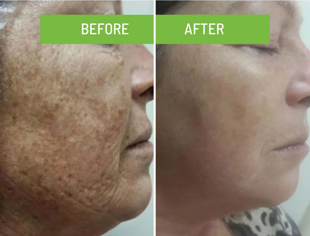 Pigmentation